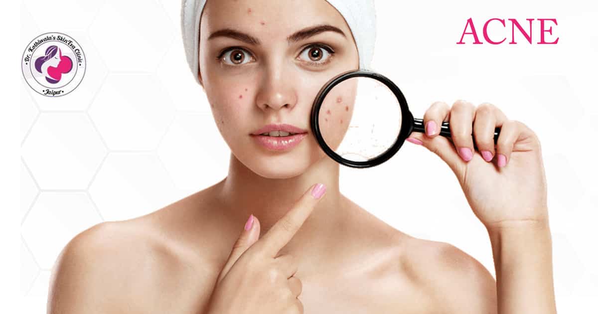Acne Laser Treatment in Jaipur Acne Doctor, Clinic & Cost Jaipur