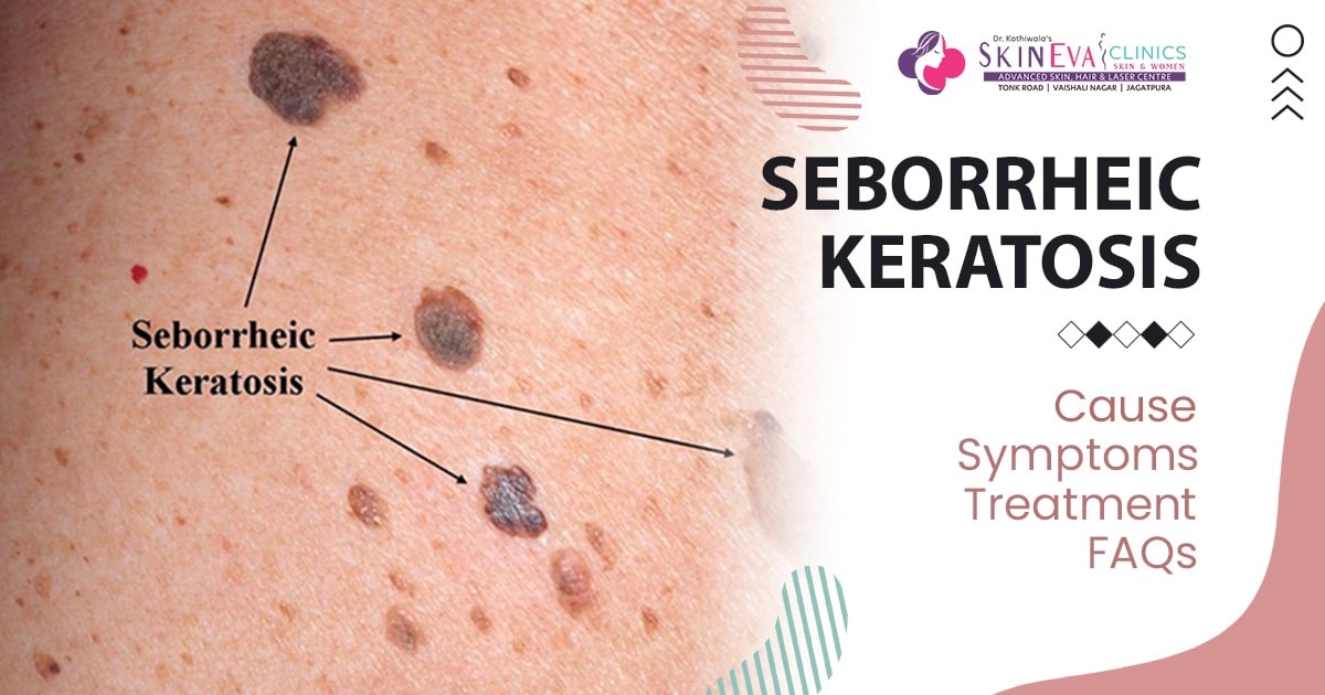Seborrheic Keratosis Treatment In Jaipur Seborrheic Keratosis Cost 