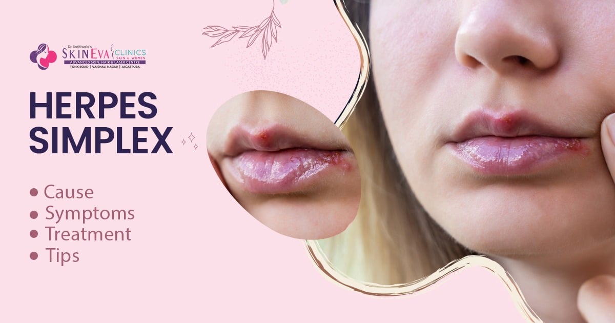 does glutathione remove herpes Cold sores treatment in jaipur, Simplex cure, cost & doctor jaipur ACTIWHITE BAR - Whiz