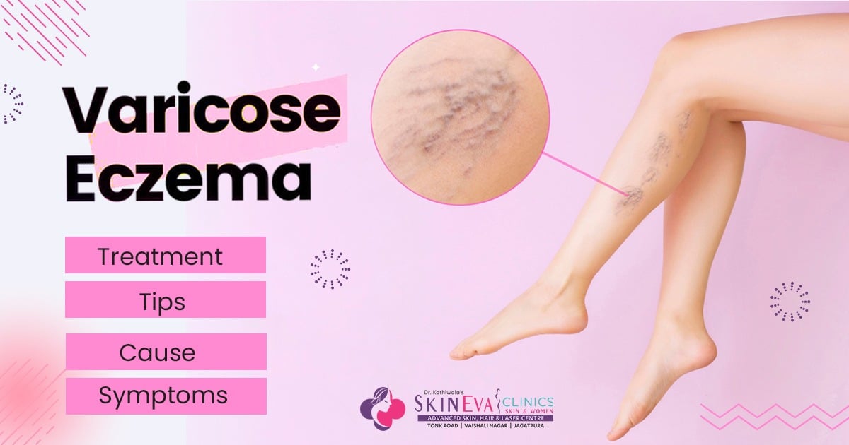 Varicose Eczema Stasis Dermatitis Treatment In Jaipur Cost Doctor 