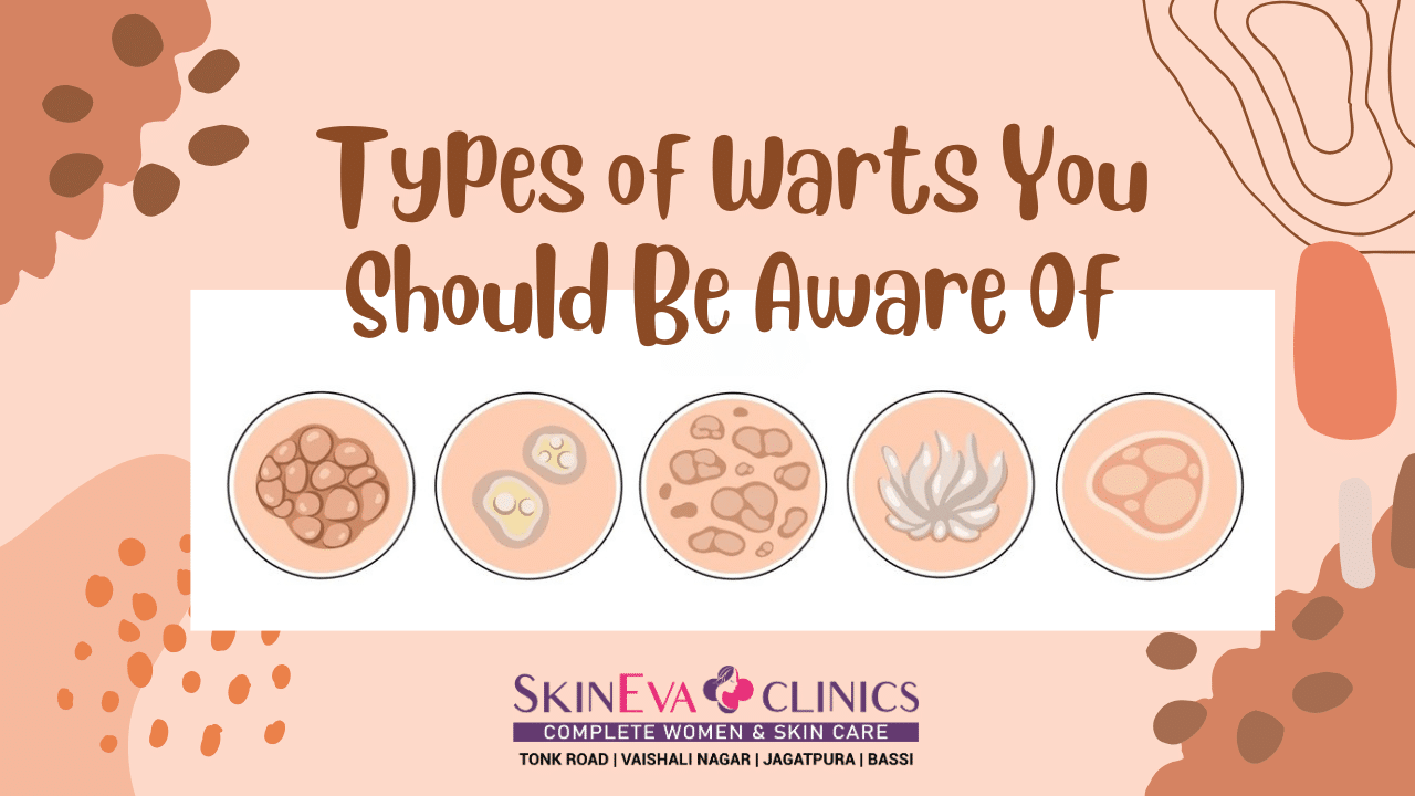 Types Of Warts You Should Be Aware Of