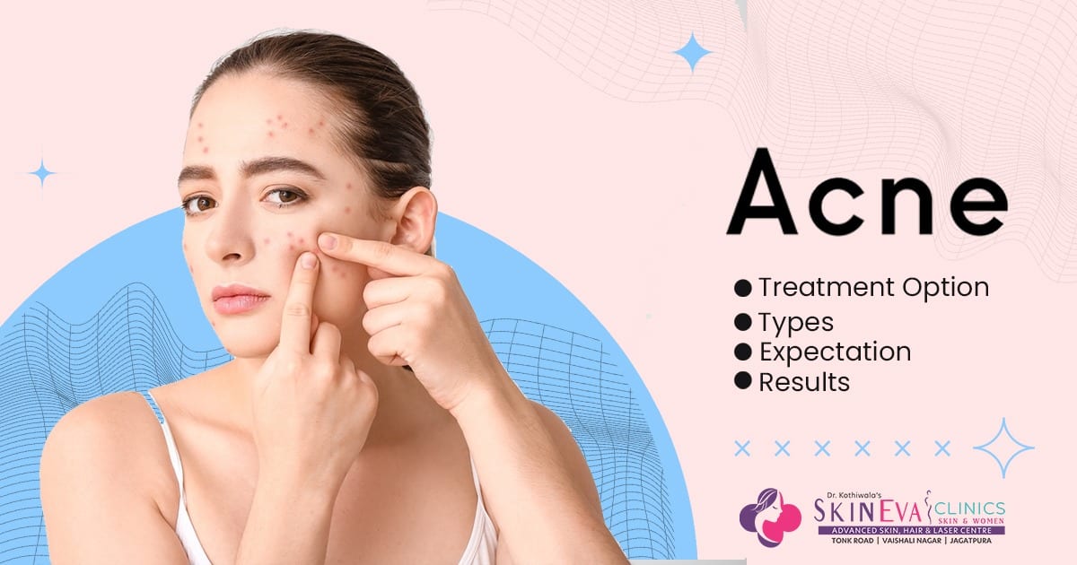Acne Laser Treatment in Jaipur | Acne Doctor, Clinic & Cost Jaipur