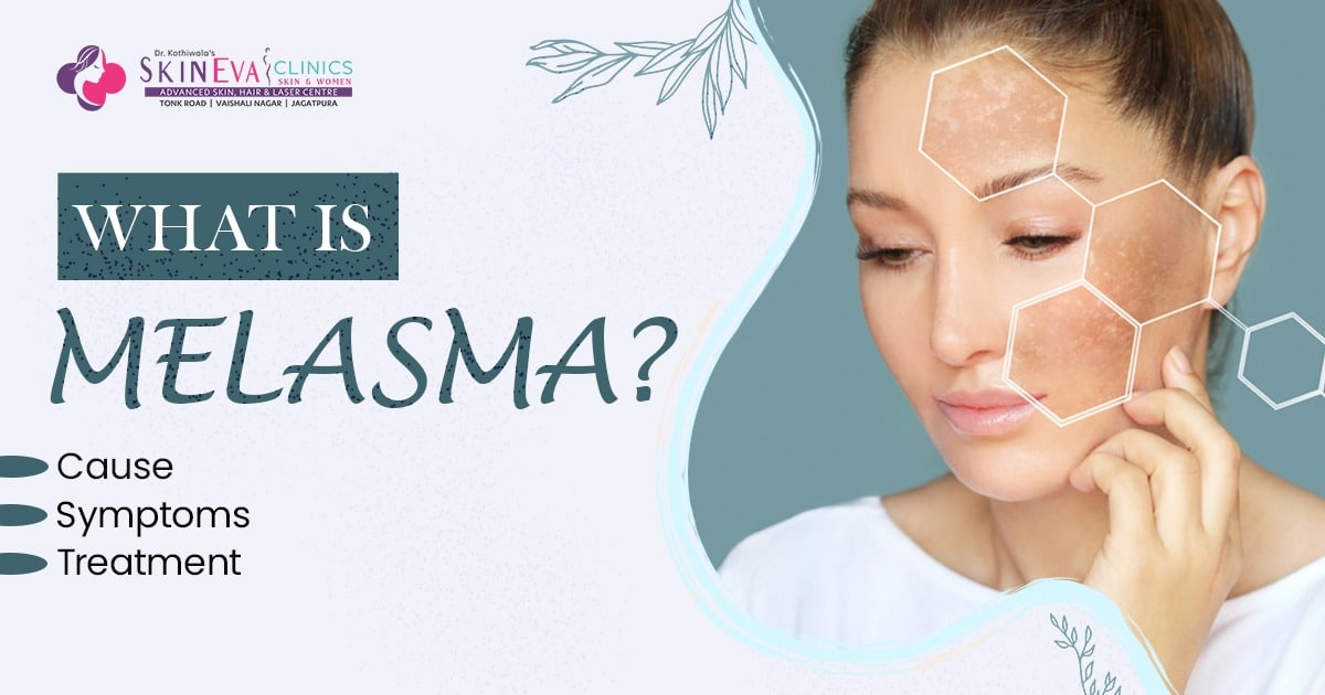 Best melasma/hyper-pigmentation treatment in Jaipur, cost & doctor jaipur